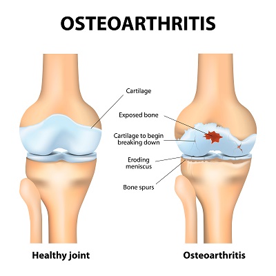 turmeric to reduce arthritis