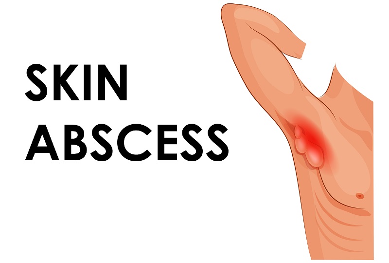 what is a skin abscess dr vivek baliga