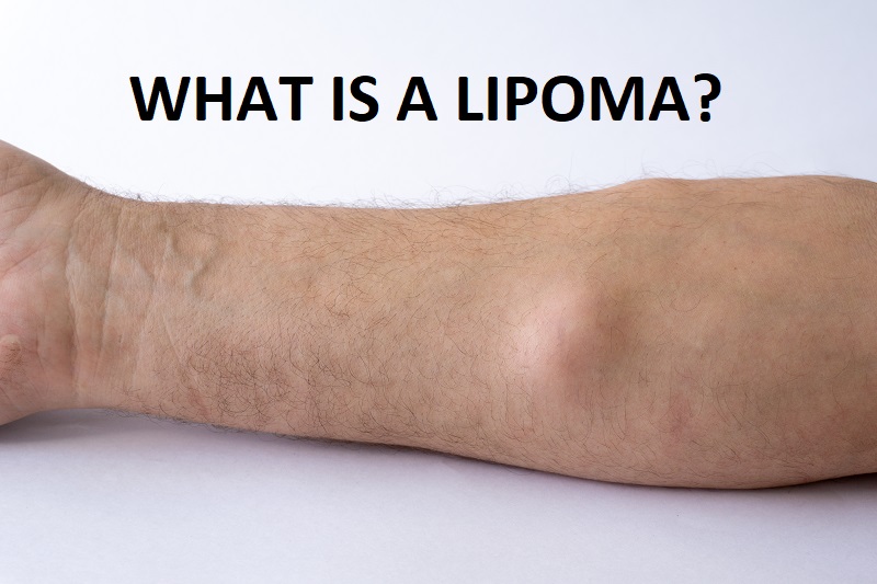 what is a lipoma?